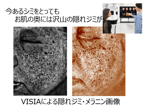 今あるシミをとっても、お肌の奥にはたくさんの隠れジミが。VISIAによる隠れジミ・メラニン画像