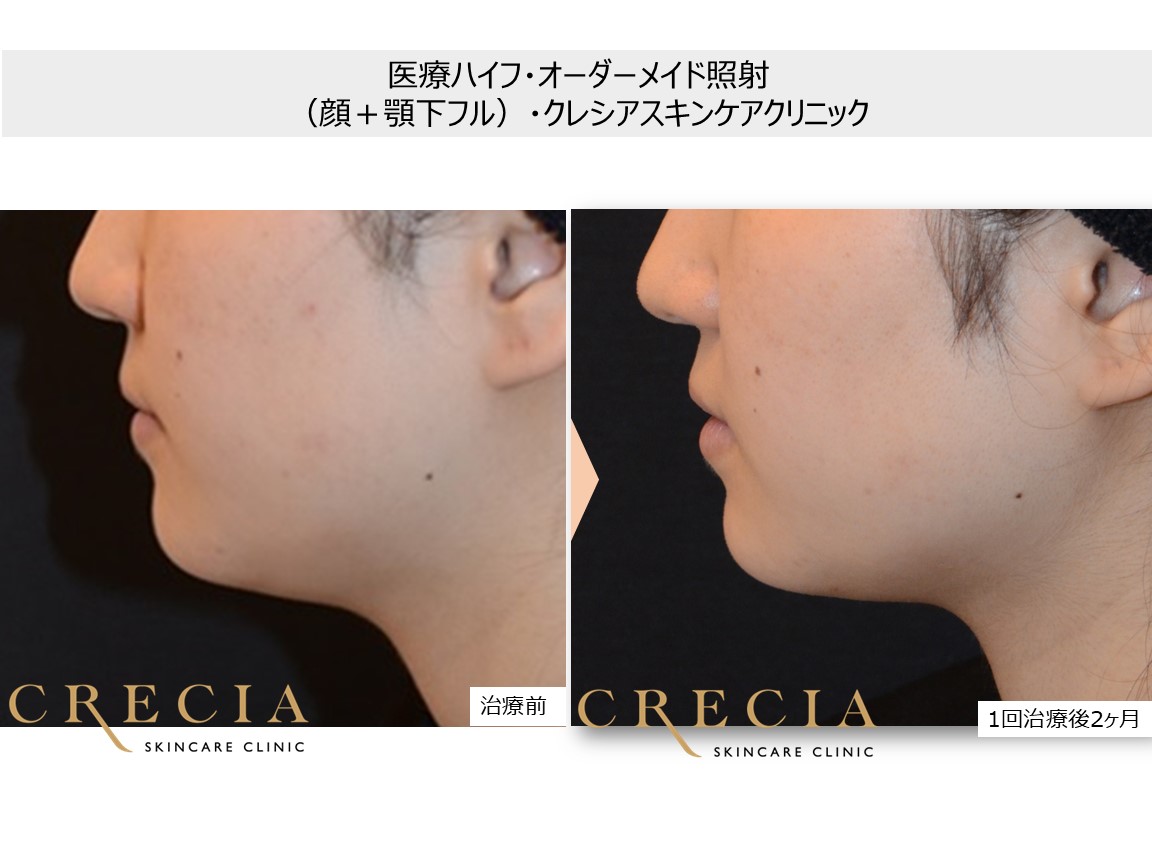 医療ハイフでフェイスラインを改善
