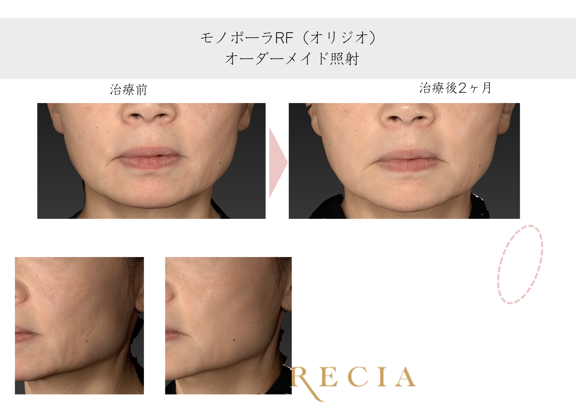 たるみが気になる（50代）