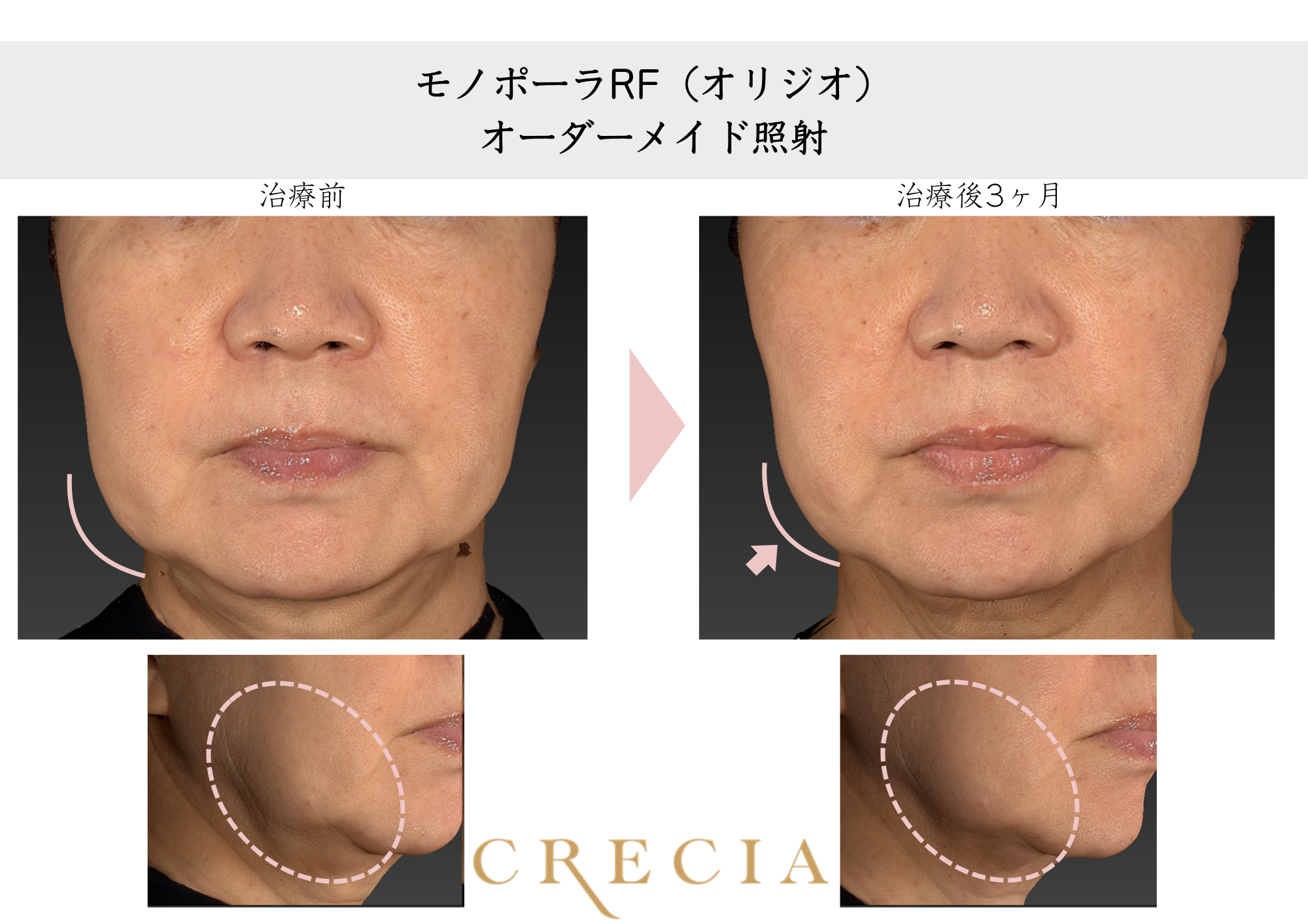 頬のたるみが気になる（60代）
