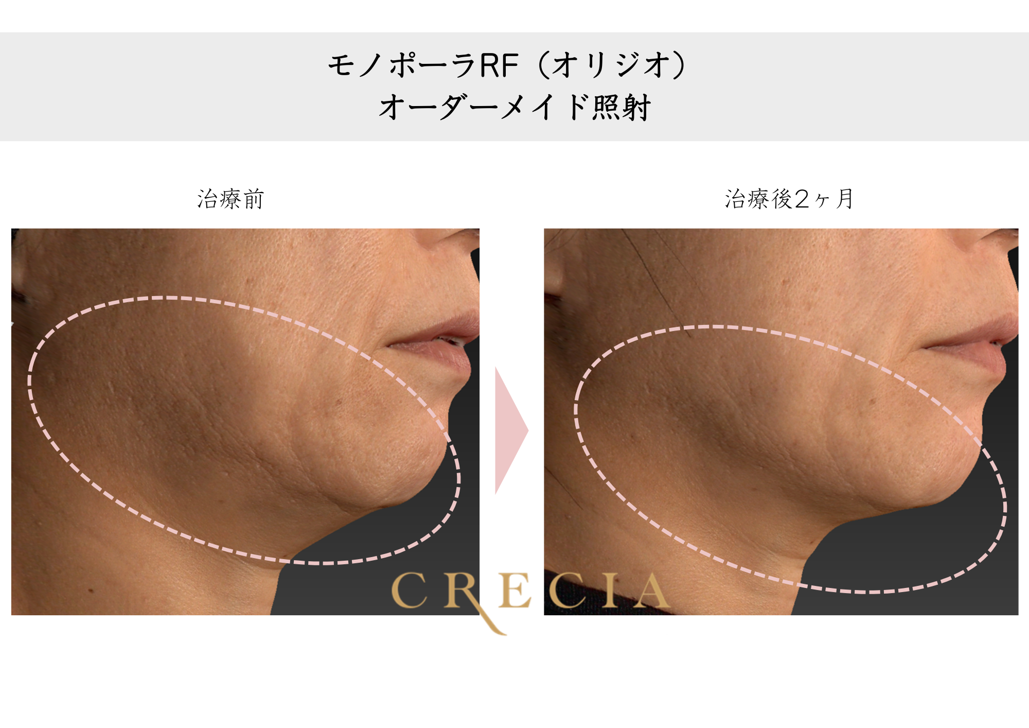 フェイスラインのたるみが気になる（50代）