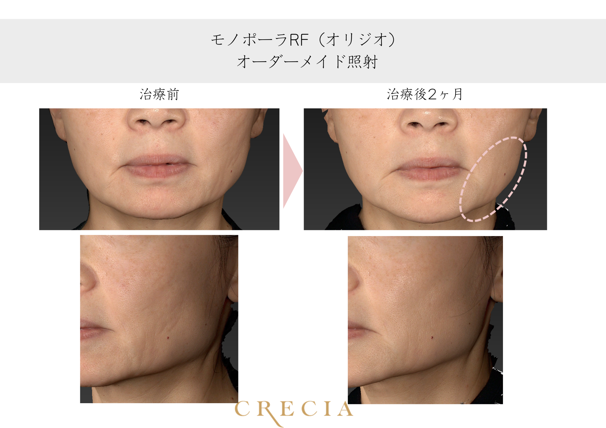 たるみが気になる（50代）